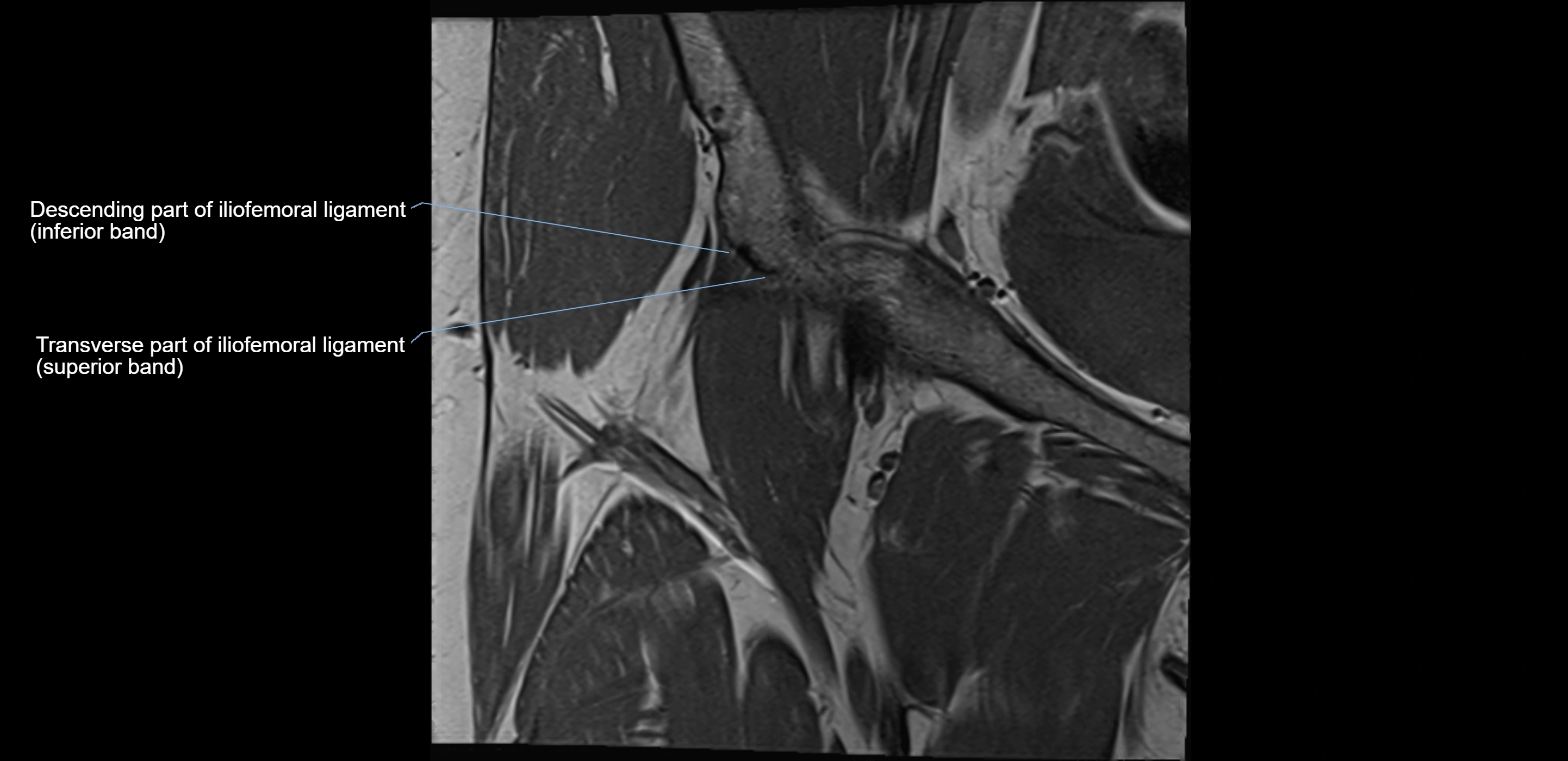 MRI Hip ligaments coronal cross sectional anatomy 3T  radiology  image-img-00001-00002.webp